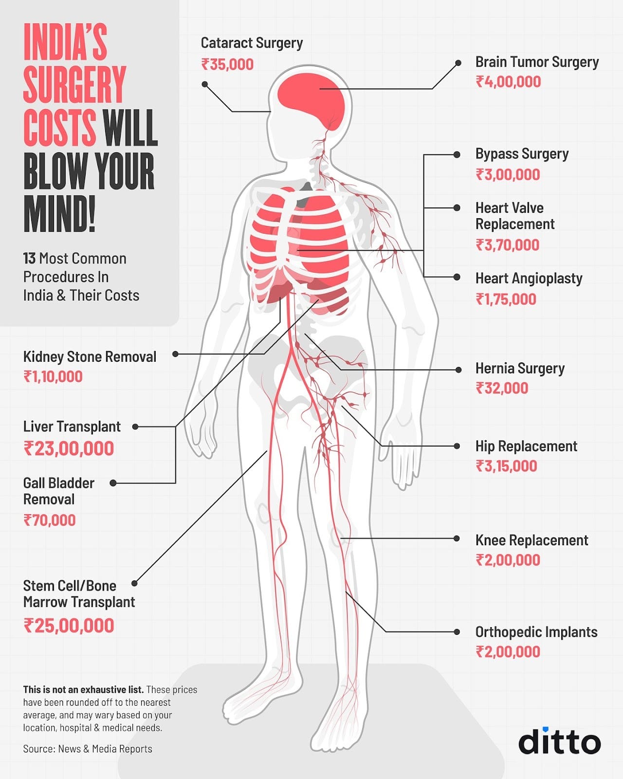 India's Surgery Costs