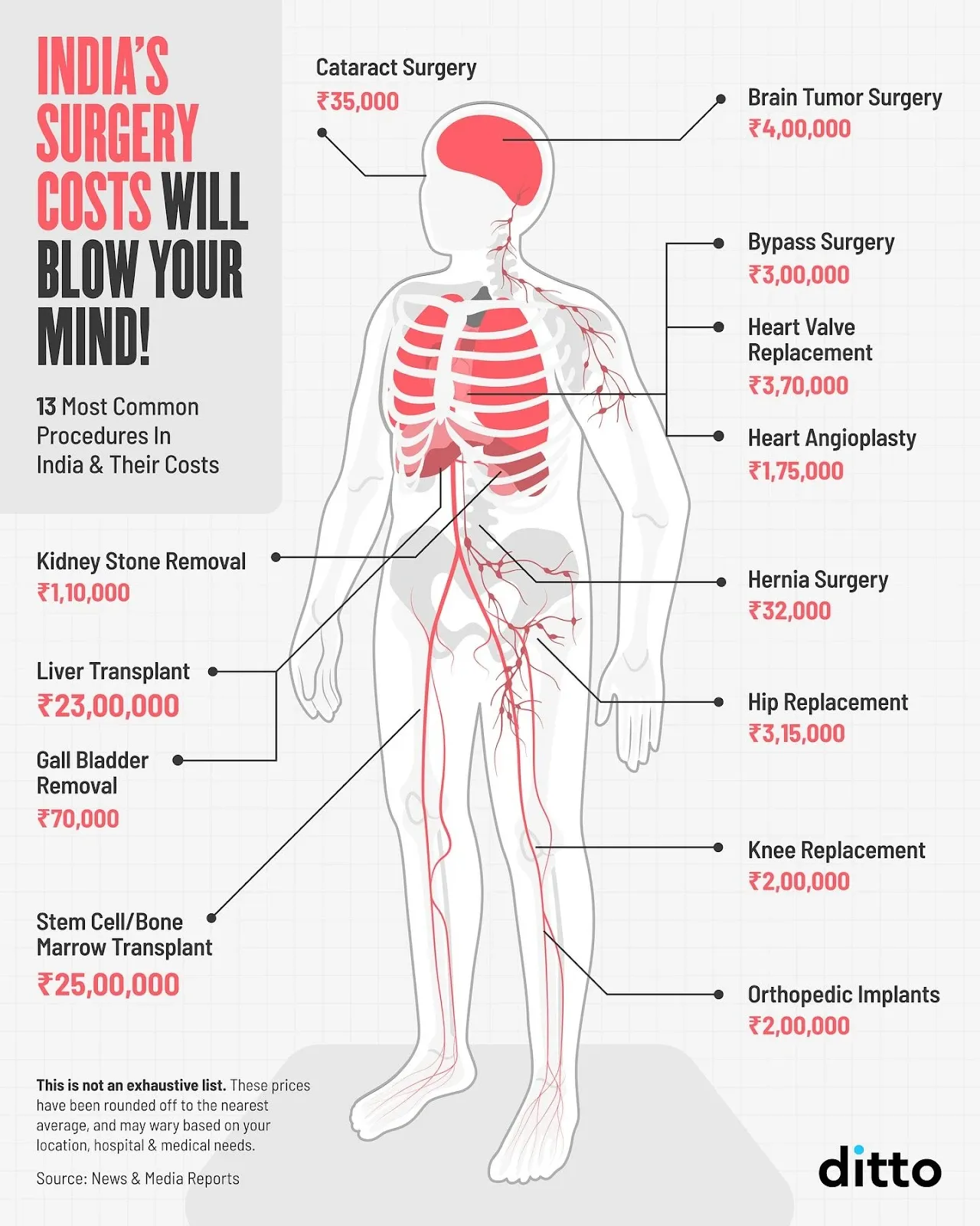 Common surgery costs in India showing estimated expenses for 13 procedures including angioplasty, transplants, replacements, and major surgeries.